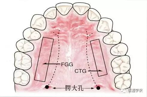 fgg(游离龈移植),ctg(结缔组织移植)的移植瓣多数情况下都是从富含