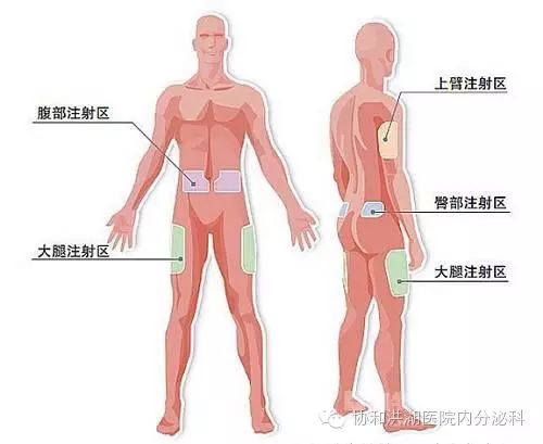 注射部位的选择 人体适合皮下注射胰岛素的部位有腹部,大腿外侧,手臂