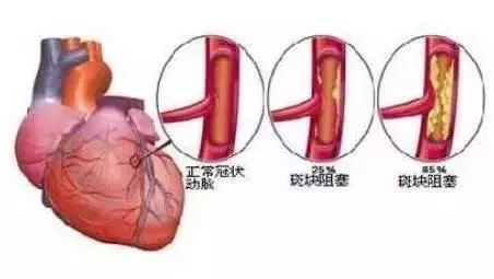 冠脉狭窄,即冠状动脉狭窄,一般指冠状动