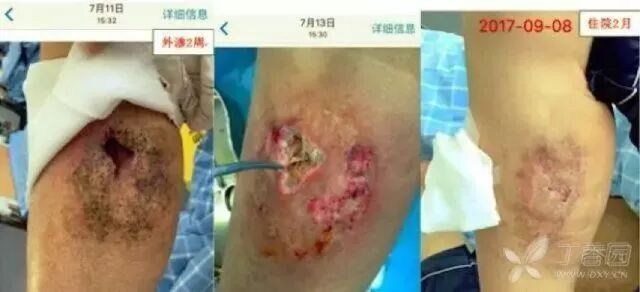 为什么要用推注泵葡萄糖酸钙注射液，4 大疑问逐个击破_https://www.jmylbn.com_新闻资讯_第3张