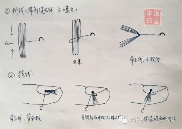 挂线疗法不需手术拔甲,在指根行环形阻滞麻醉,麻醉满意后对病甲