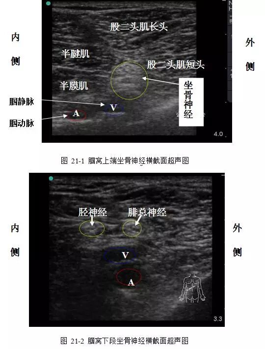 超声引导下区域麻醉/镇痛的专家共识