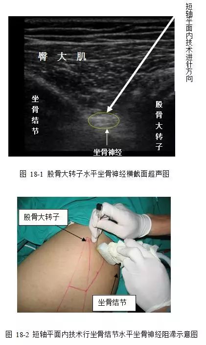 十九,臀下入路坐骨神经阻滞