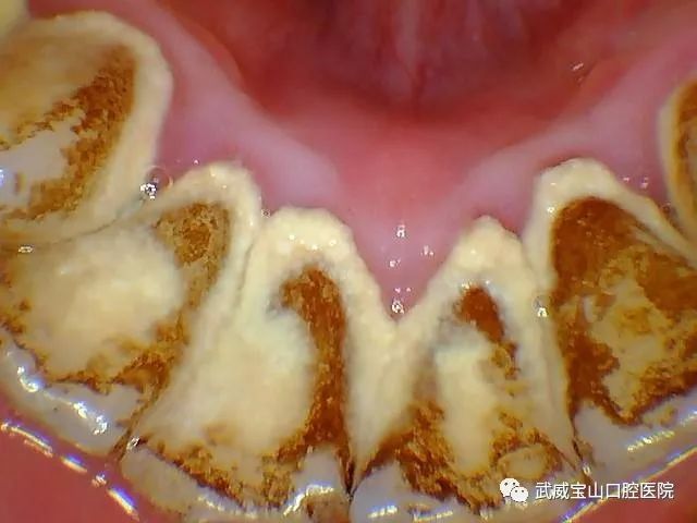 牙结石牙垢太可怕了(科普知识 ㄨí遦箛啴╲的主页