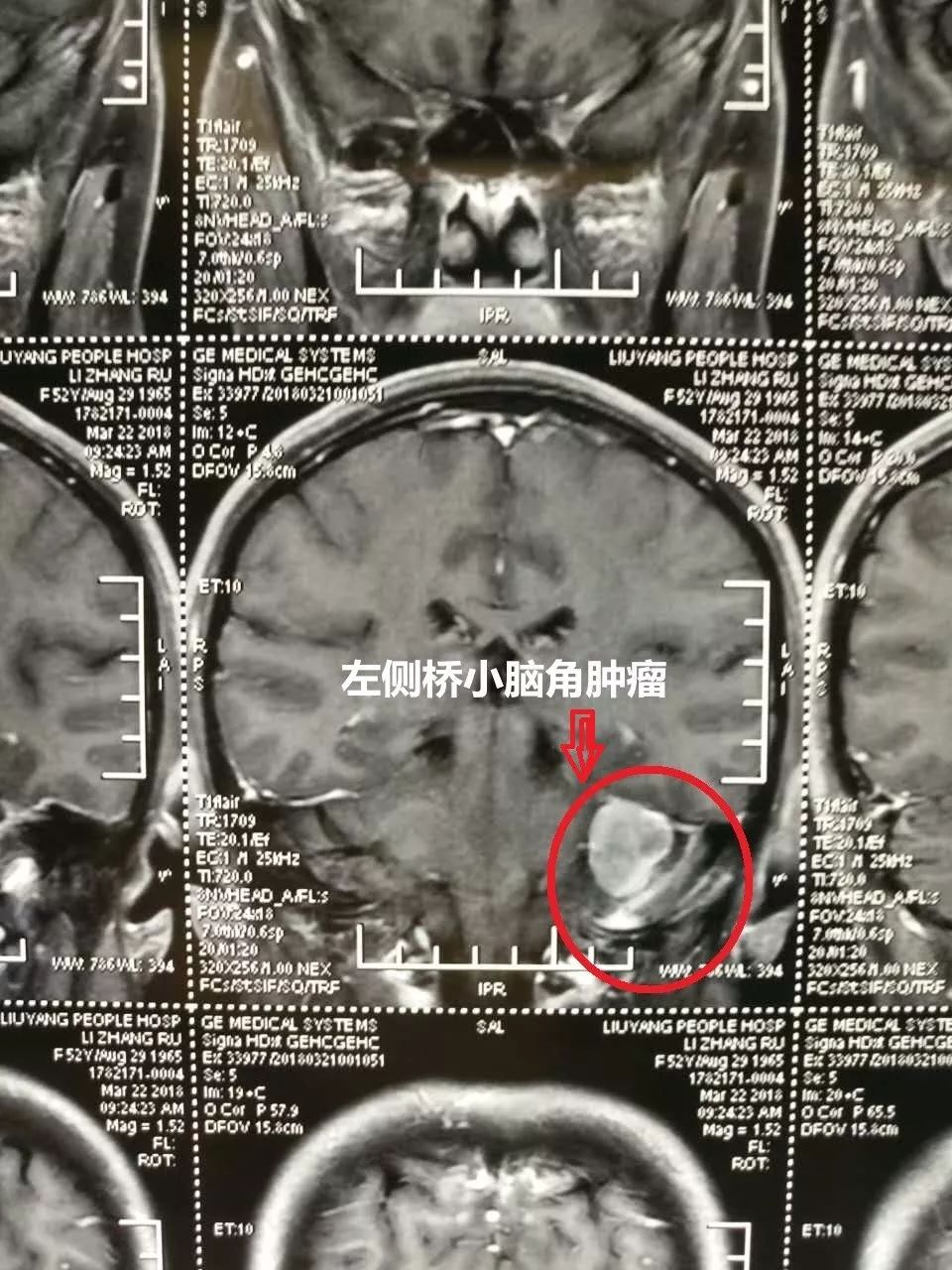 患者左侧桥小脑角肿瘤