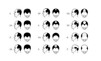 陈学荣教授漫谈斑秃治疗
