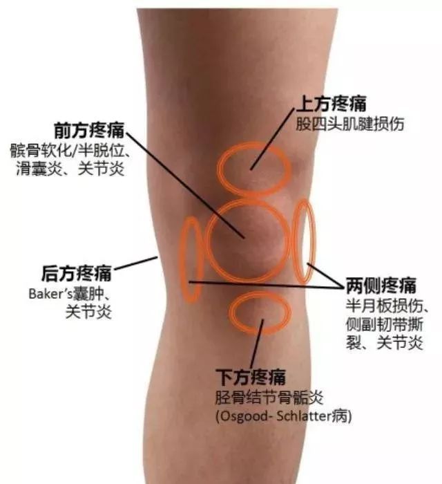 一张图告诉您,膝盖疼痛位置与对应病症!太实用了!