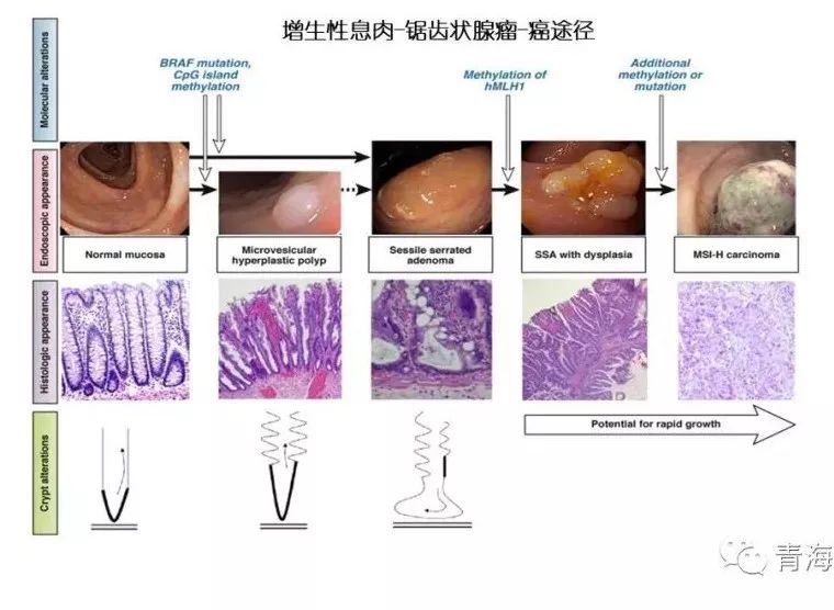 ssa/ps占锯齿状息肉的20%,通常为无蒂或扁平病灶,多见于右结肠,多