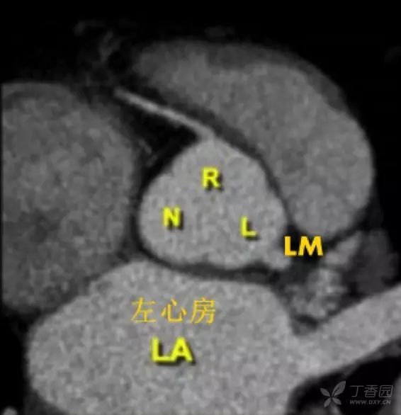 ct 显示三个主动脉窦,左冠窦 l,右冠窦 r,无名窦 n