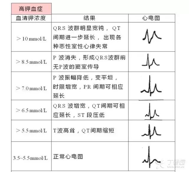 高钾血症心电图