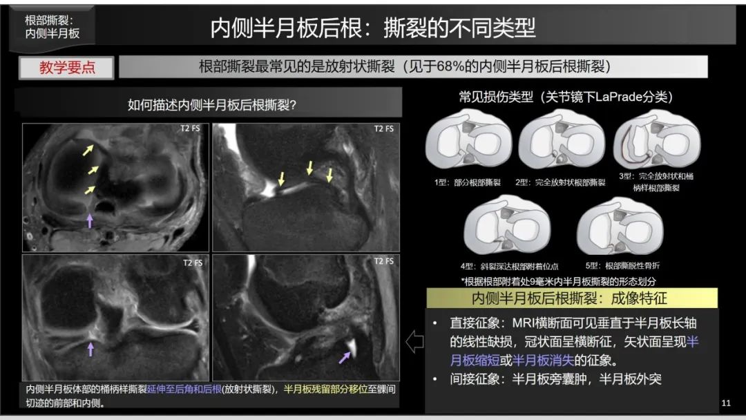 半月板根部ramp区修复及其后遗症mr表现