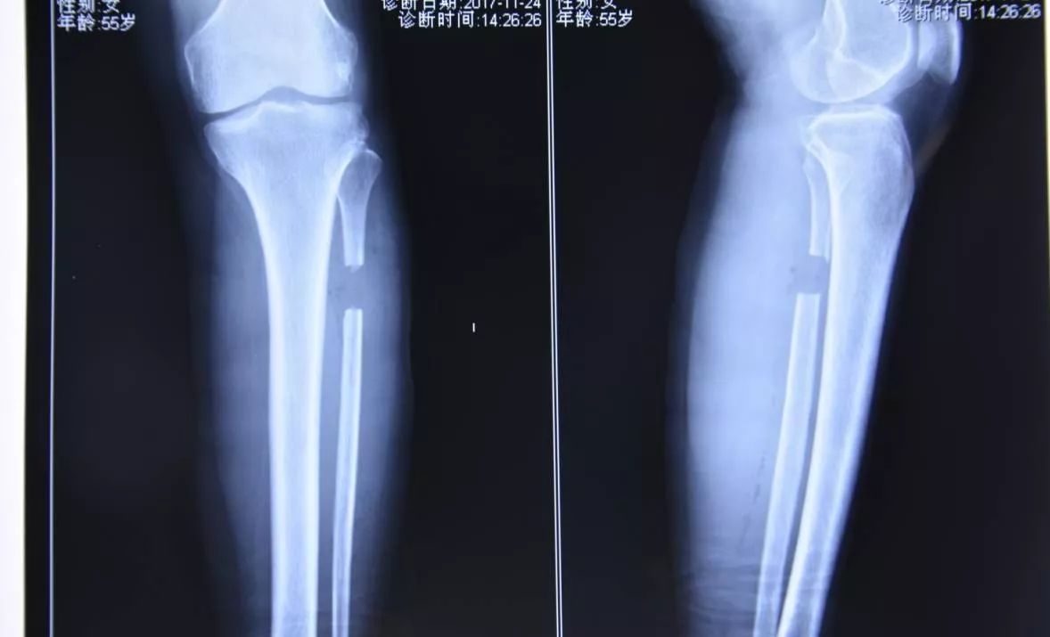 【灵中医丨下肢骨伤病区】腓骨截骨术--告别膝关节疼痛