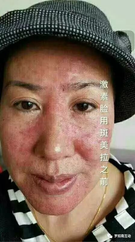 激素脸案例
