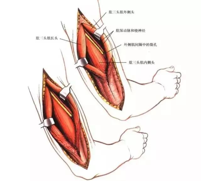 肱三头肌是由三个头组成——外侧头,长头和内侧头.