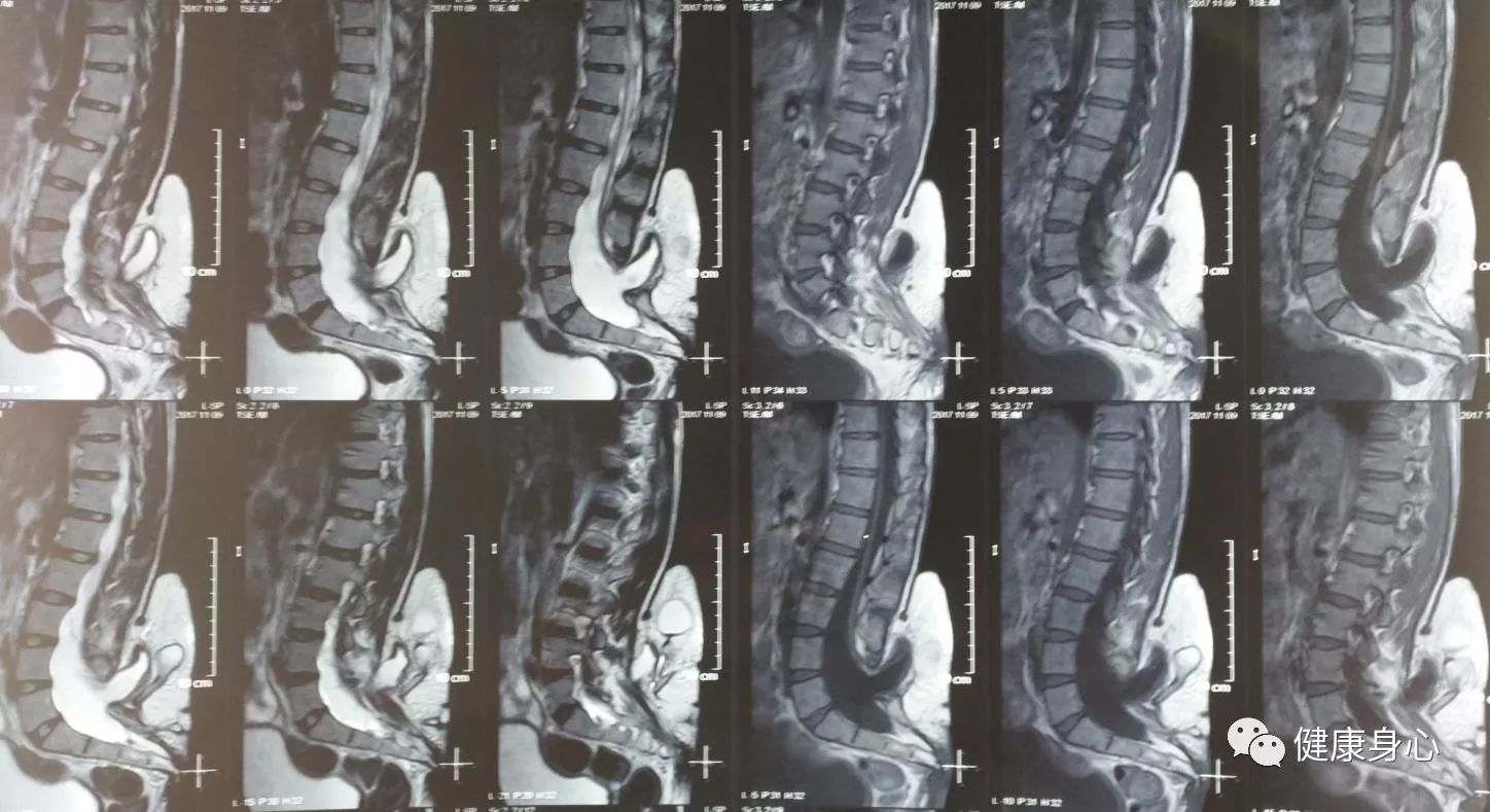 磁共振提示脊髓脊膜膨出,脊髓拴系,尿潴留