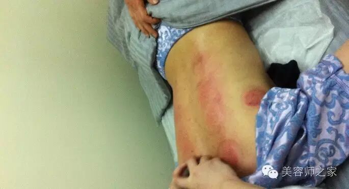 走罐疗法：疏通经络、行气活血