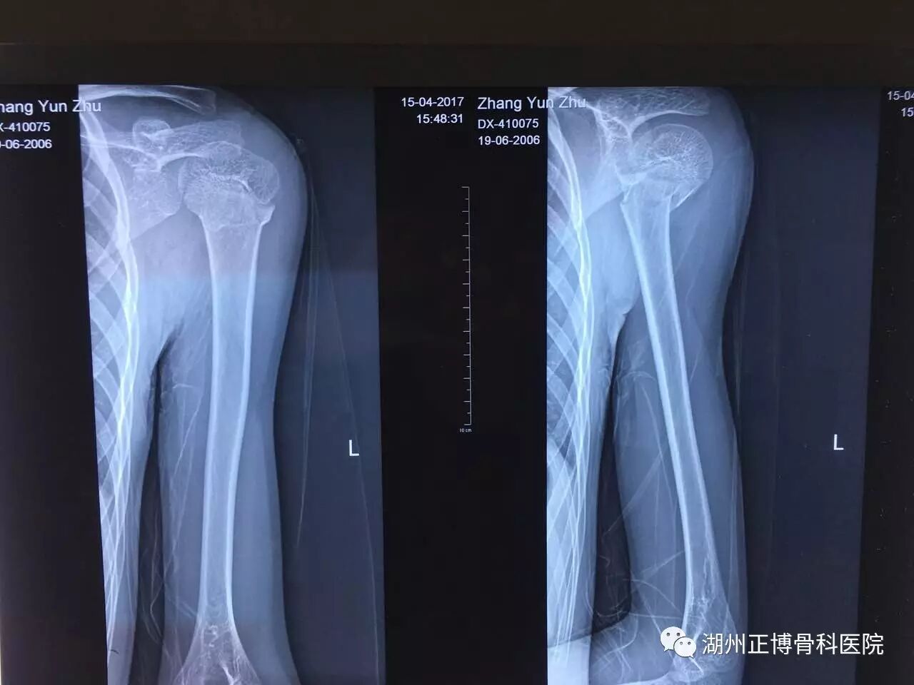 出事当天拍的x光片