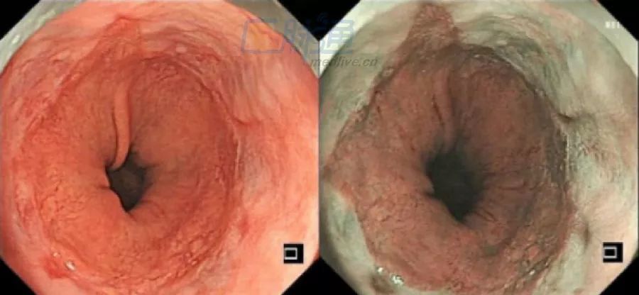 食管病变图谱(白光与nbi)