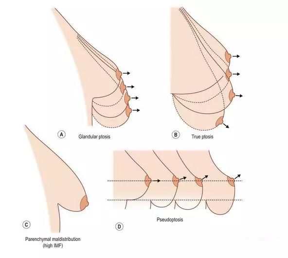 乳房实质分布异常(一般属于发育异常,下半球组织少,乳房下皱襞高,乳头