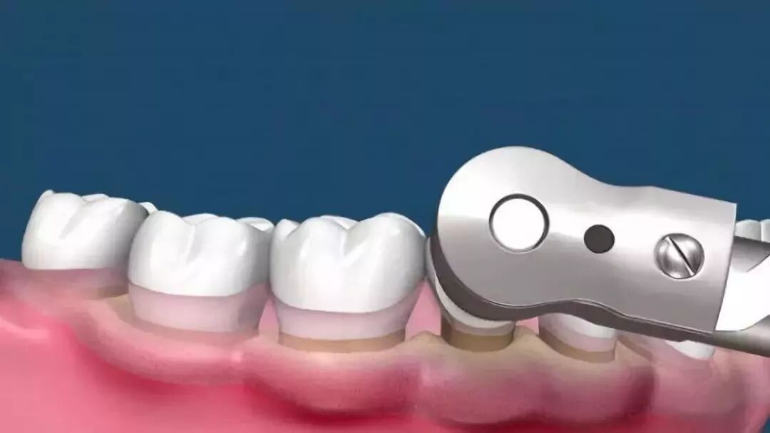 怎么选洁牙器械【诺美口腔·4店适用】49.9元享洁牙套餐：口腔健康档案、全口口腔问题诊断、无菌治疗器械、成人超声波洁牙...._https://www.jmylbn.com_新闻资讯_第28张