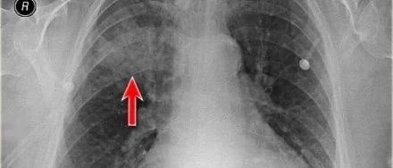 胸疾病胸片表现之肺实变