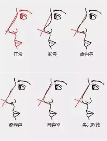 根据各种不同鼻型的隆鼻需求