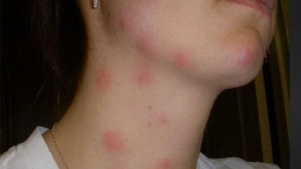 英国天气炎热，容易滋生Bed bug，被咬了怎么办？