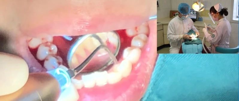 牙周洁刮治术的标准操作方法