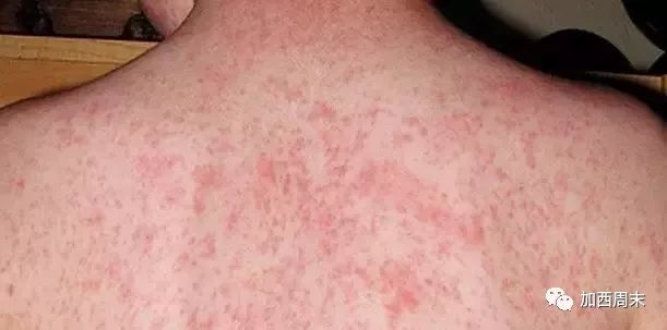 大温卫生局警告！又发现麻疹患者 天车、华人最爱公园都沦陷 附最全疫苗指南