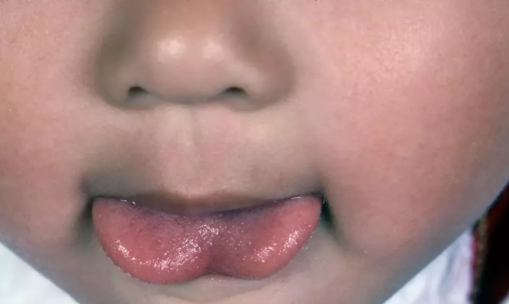 不过,并非所有舌系带短的患儿都会出现发音不清症状.