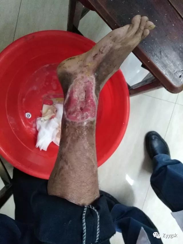 左外踝烧伤后骨髓炎并皮肤软组织缺损骨外露