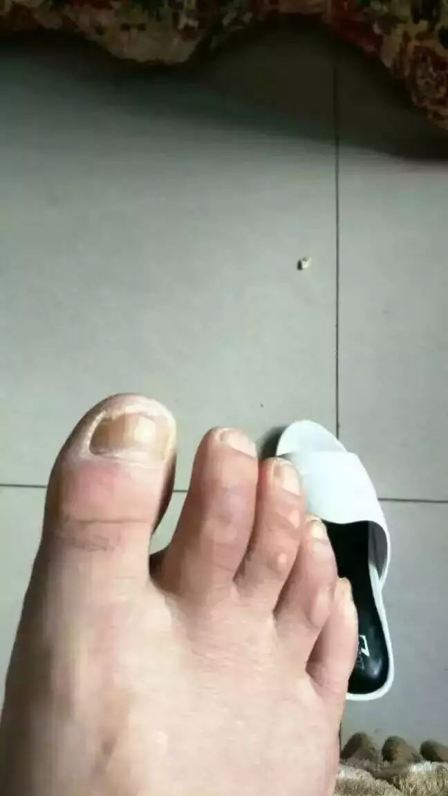 医院4,案例宜昌湖北一初中这是的脚,长期痒,录取泡,在学生v医院许久出水初中部分数线九中图片