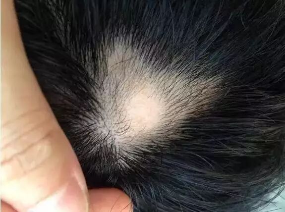 脱发真的能治愈吗？