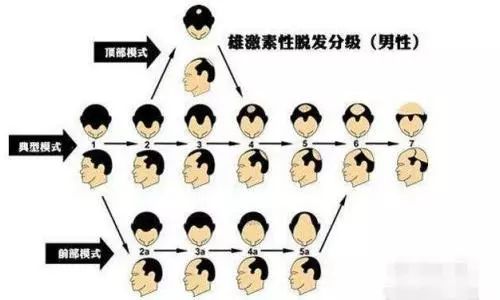 家里人明明没有脱发的啊我怎么就得了遗传脱发了呢
