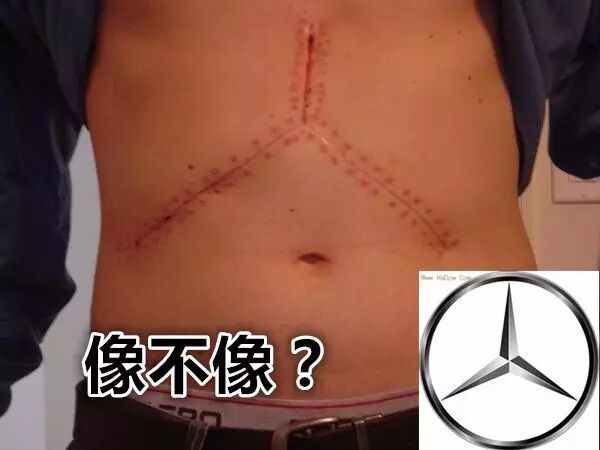 止血钳怎么造绝非歧视，但外科医生为什么不喜欢给胖人做手术？_https://www.jmylbn.com_新闻资讯_第5张