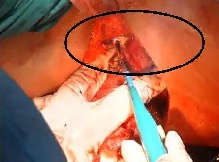 止血钳怎么造绝非歧视，但外科医生为什么不喜欢给胖人做手术？_https://www.jmylbn.com_新闻资讯_第6张