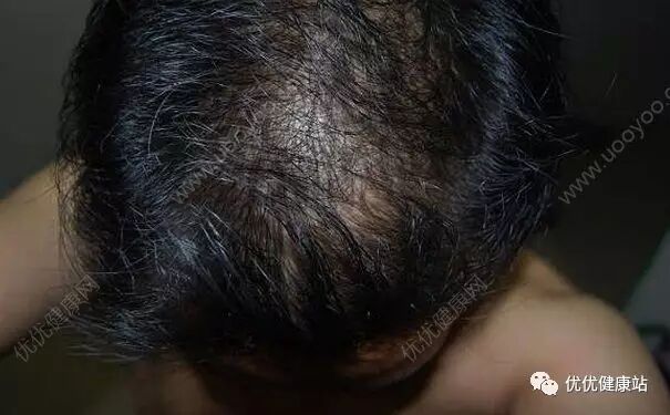 严重脱发吃什么好？掉头发很厉害怎么办？