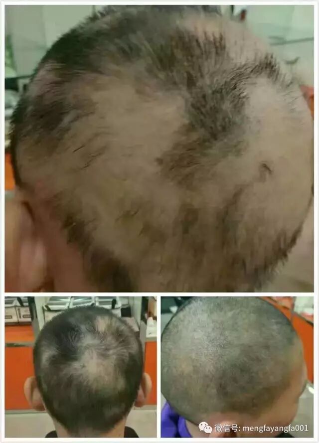 斑秃、脂溢性脱发、白发、毛囊炎、使用案例