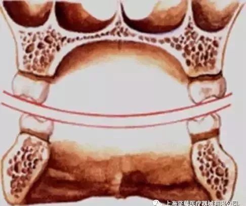 (三)wilson曲线: ①上颌连接两侧同名磨牙的颊尖,舌尖形成一条凸向下