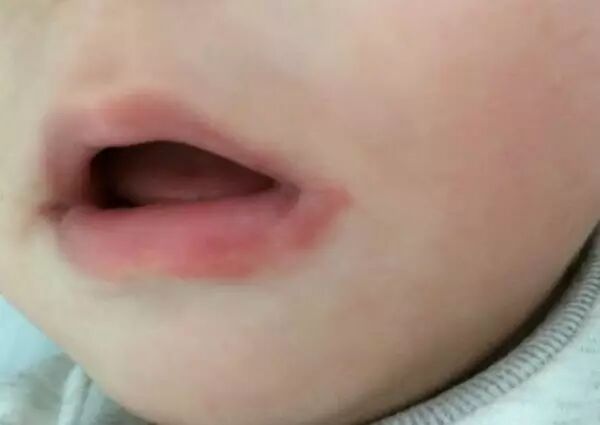 影响孩子食欲的4种口腔疾病 得赶紧治！