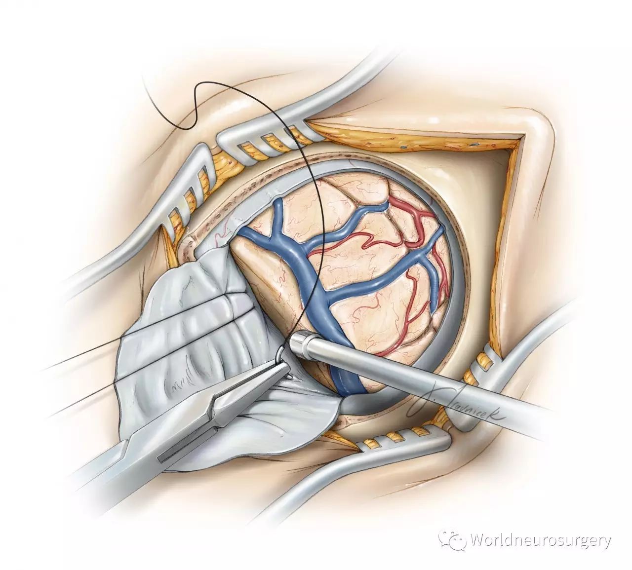 旁矢状窦开颅术--the neurosurgical atlas系列