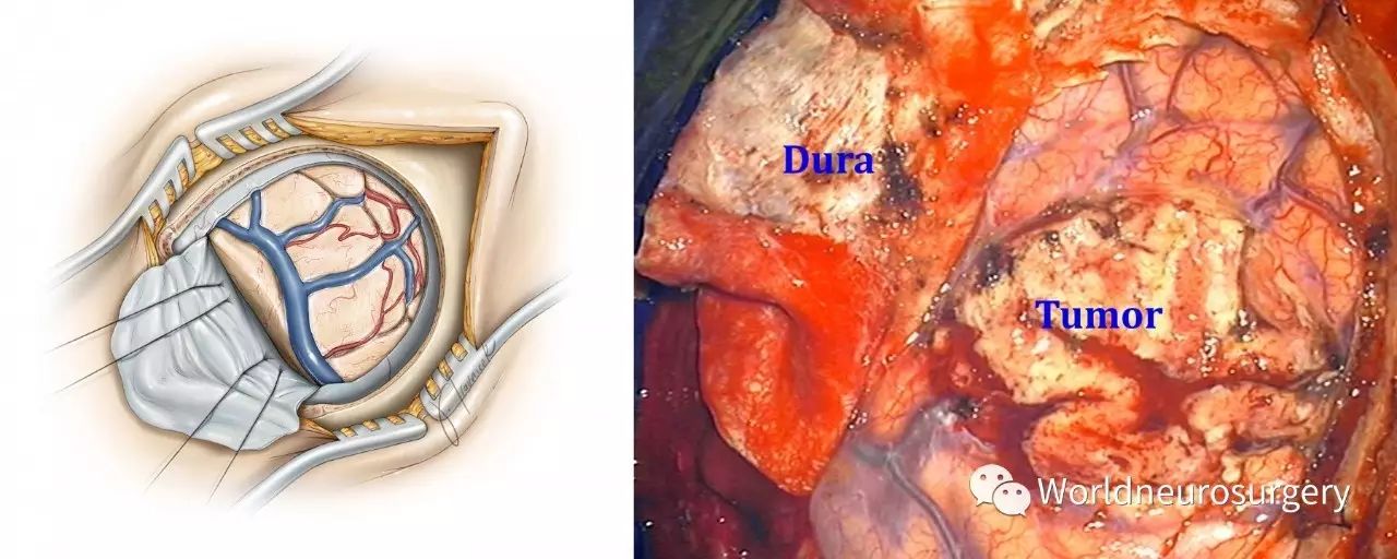 严密缝合硬脑膜是可取的,不过在幕上病变的病例中,我通常不强求硬膜