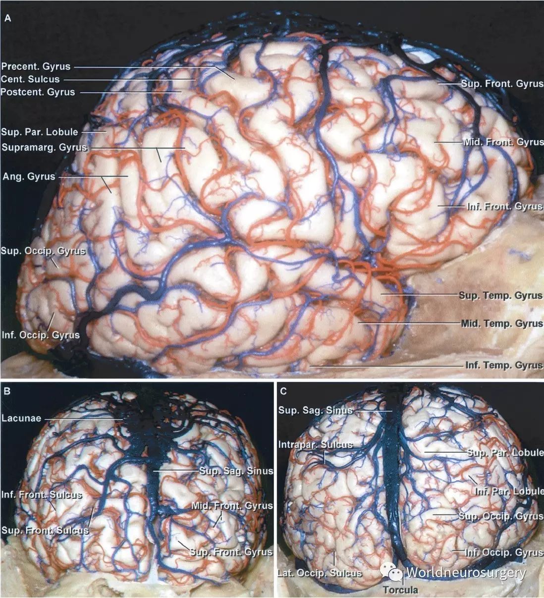 神外医生基本功--顶叶开颅术--the neurosurgical atlas系列