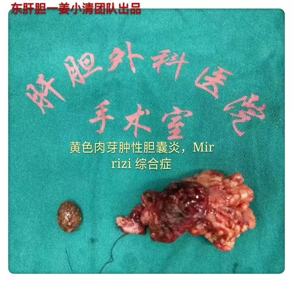 医学手绘 | 结石性黄色肉芽肿性胆囊炎(xgc)并mirizzi