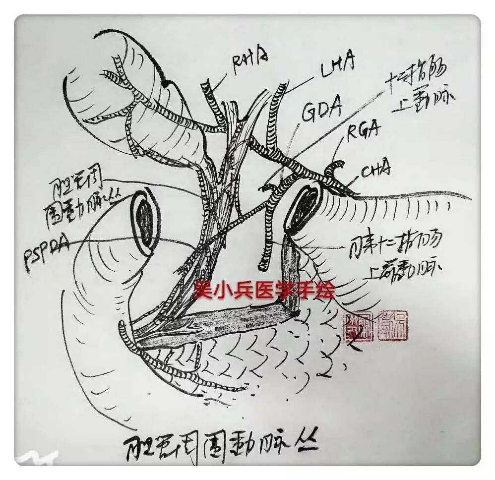 【手绘图】肝胰十二指肠切除(hpd )治疗胆囊癌