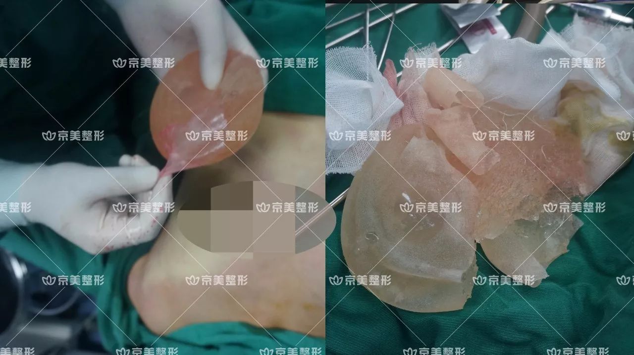 取假体自体脂肪丰胸手术全程解密,你一定没看过!