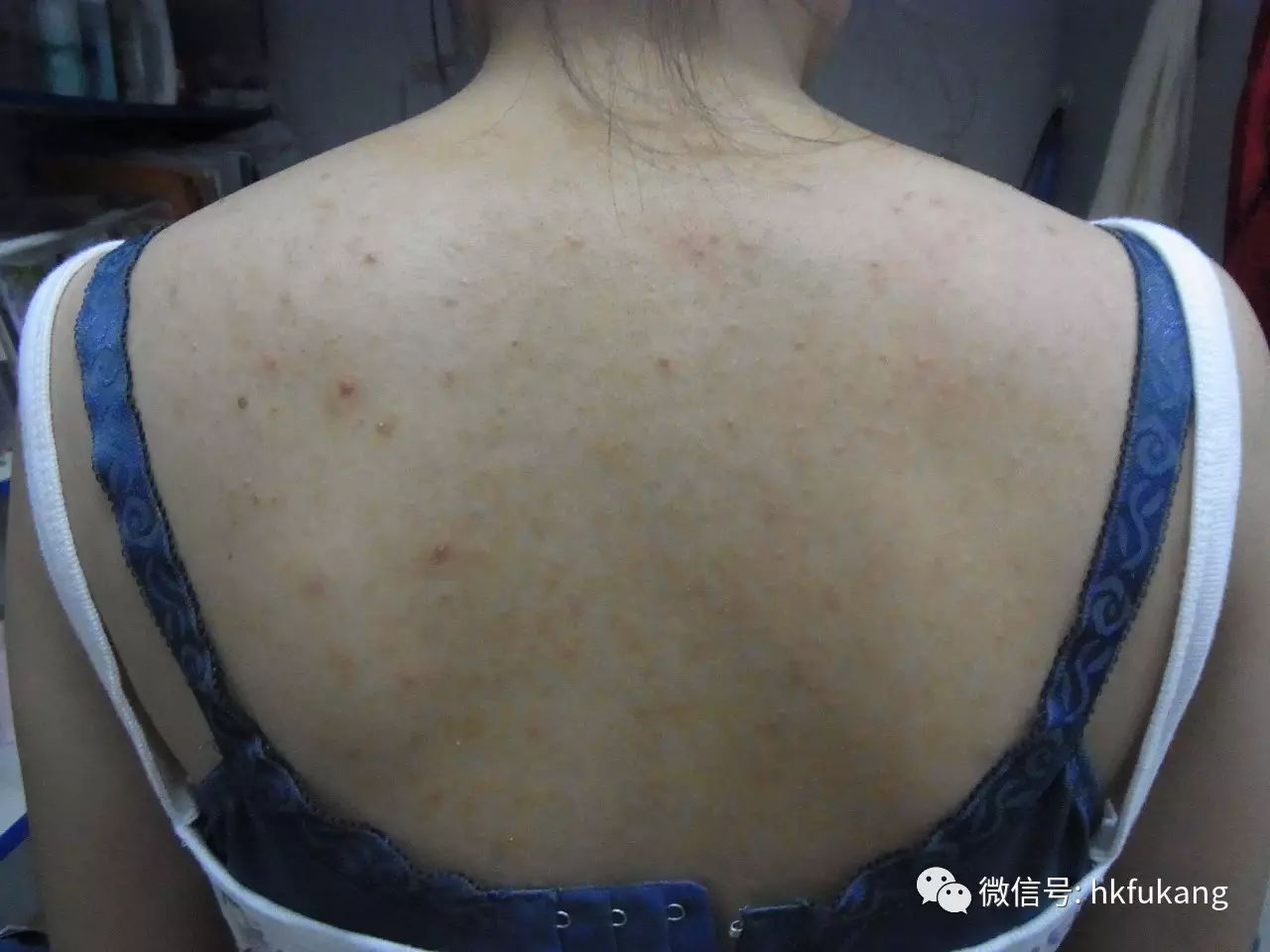 丝状疣是瘊子疾病当中的一种,是由人类乳头瘤病毒所引起的,发生于皮肤