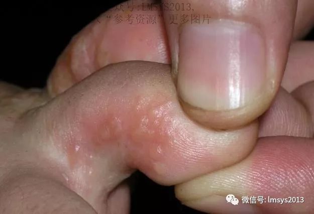 三,汗疱疹会传染吗? 汗疱疹没有传染性. 四,汗疱疹与手足癣如何鉴别?