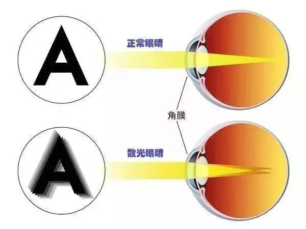 有一种眼病，危害跟近视差不多，却一直被忽视！