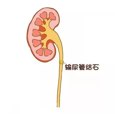 在输尿管第二个狭窄部—— 髂血管跨越处 第三站: 输尿管跨越髂血管处